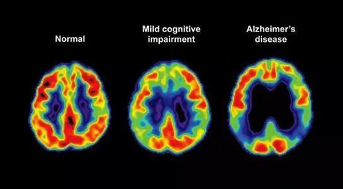 阿尔茨海默氏症是一种由脑细胞逐渐退化引起的神经退行性疾病