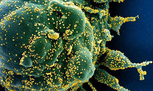 从患者样本中分离出严重感染SARS-COV-2病毒颗粒（黄色）的凋亡细胞（绿色）的彩色扫描电子显微照片