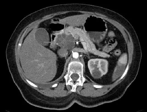Axial CT images of pancreatic head carcinoma and cystadenocarcinoma with iv contrast