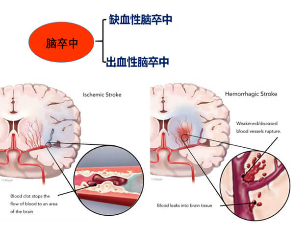 1-脑中风主要有缺血性中风和出血性脑卒中.jpg