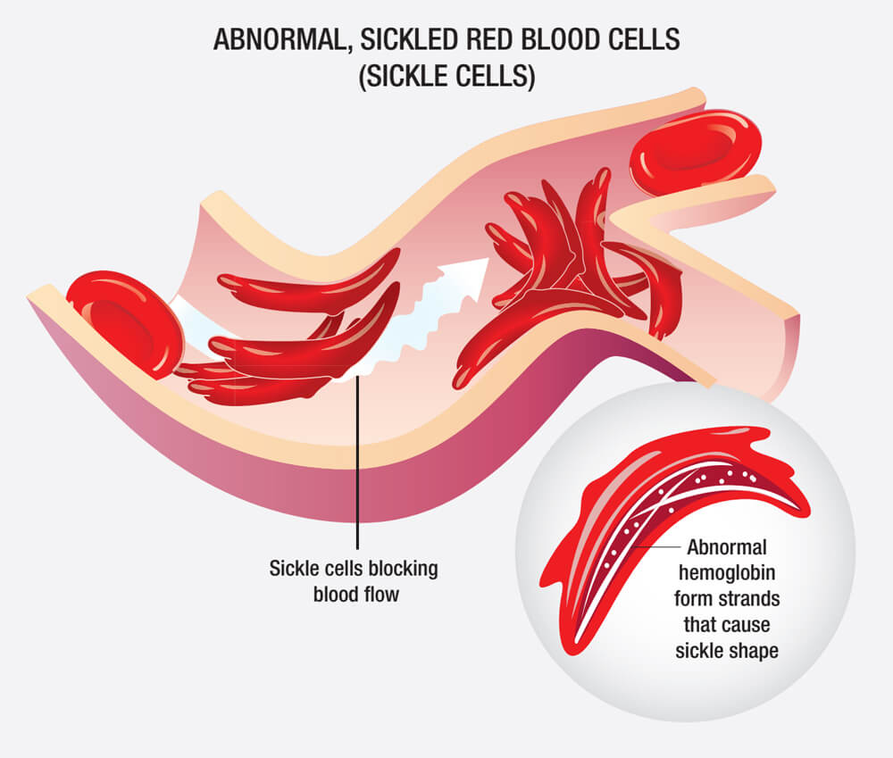 镰刀状异形红细胞（图源：NIH）.jpg