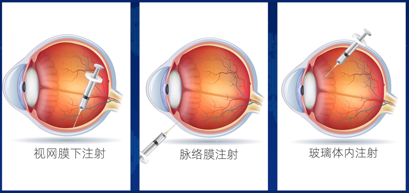 眼科疾病模型.webp